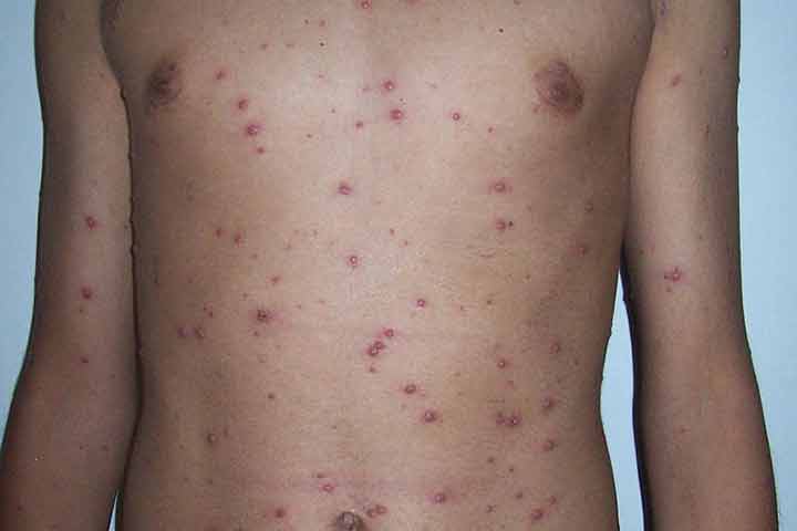 Se han detectado 602 casos de varicela en Querétaro